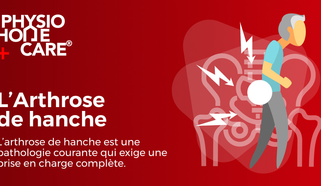 L’arthrose de hanche : prise en charge en physiothérapie